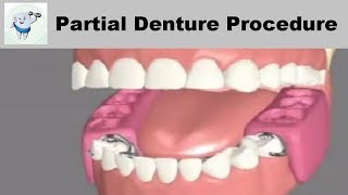 Removable Partial Dentures Steps [upl. by Powe]