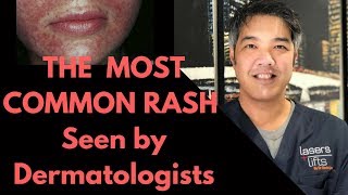 How to treat Perioral Dermatitis Dermatologist Explains [upl. by Percival]