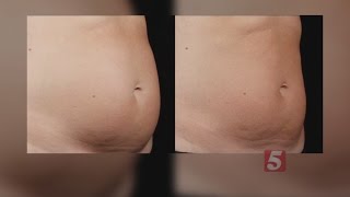 SculpSure Fat Melter Doesnt Involve Surgery [upl. by Atiluj]