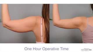 Get Firm Sculpted Arms With Smartlipo™  Dr Sterry Explains [upl. by Hsirt312]