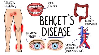 Behcets Disease  Signs and Symptoms with Triad  Pathophysiology  Criteria amp Treatment [upl. by Ahsilra]