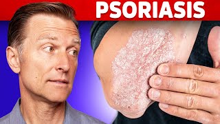 Psoriasis Treatment – The Best 3 Remedies for Psoriasis – DrBerg [upl. by Htennek]