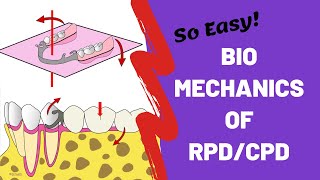 Biomechanics of Removable Partial Dentures  Prosthodontics [upl. by Roinuj272]